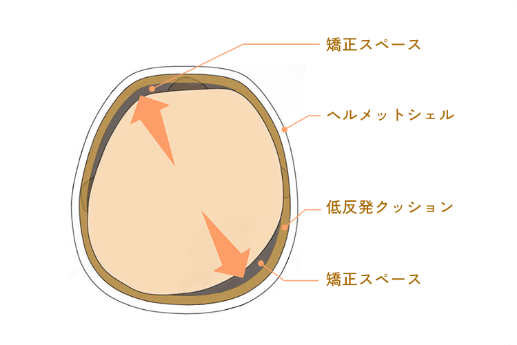 頭の成長をやさしく導くヘルメット治療の仕組み