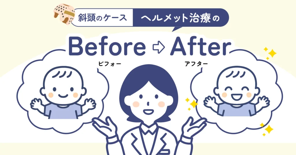 「0歳からの頭のかたちクリニック」でヘルメット治療を受けた赤ちゃんのBefore／Afterを見てみましょう（斜頭に対する治療例）