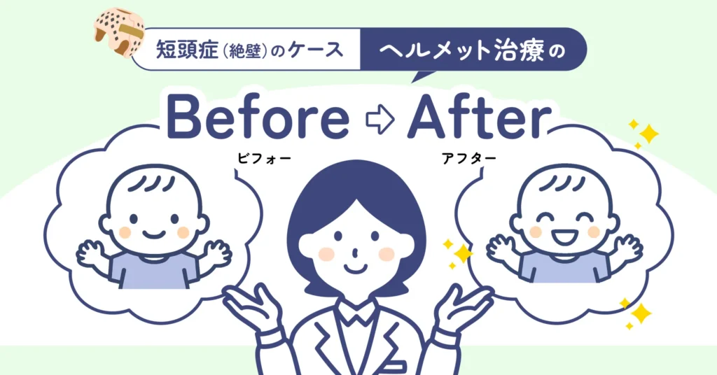 「0歳からの頭のかたちクリニック」でヘルメット治療を受けた赤ちゃんのBefore／Afterを見てみましょう（短頭（絶壁）に対する治療例）