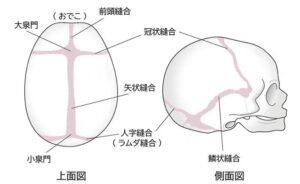 頭蓋骨縫合早期癒合症の図