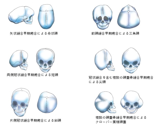 頭蓋縫合 頭蓋縫合 頭蓋骨縫合早期癒合症 マーク・G 頭蓋縫合早期癒合症 慶應