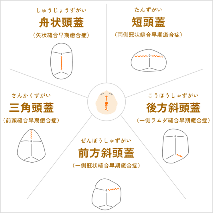 頭蓋骨縫合早期癒合症